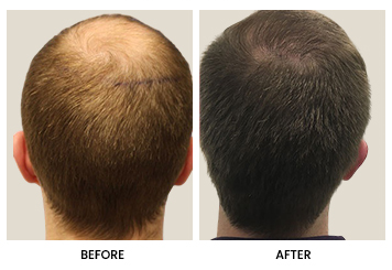 Crown And Density Restoration