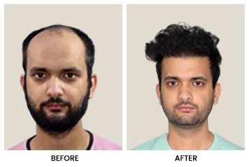 Hairline Design with Zigzag Pattern